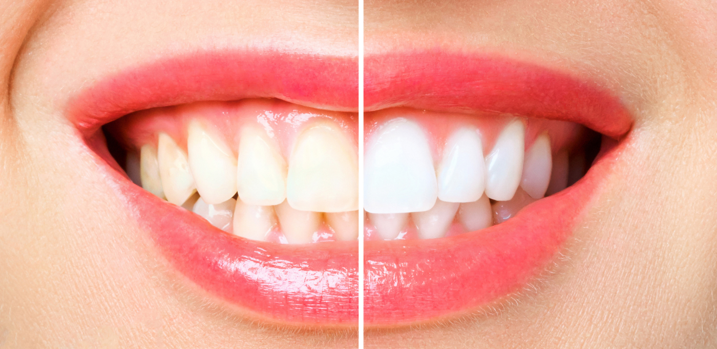 Tooth Whitening Trends 2025: What Works, What’s Safe, and What’s Worth It?