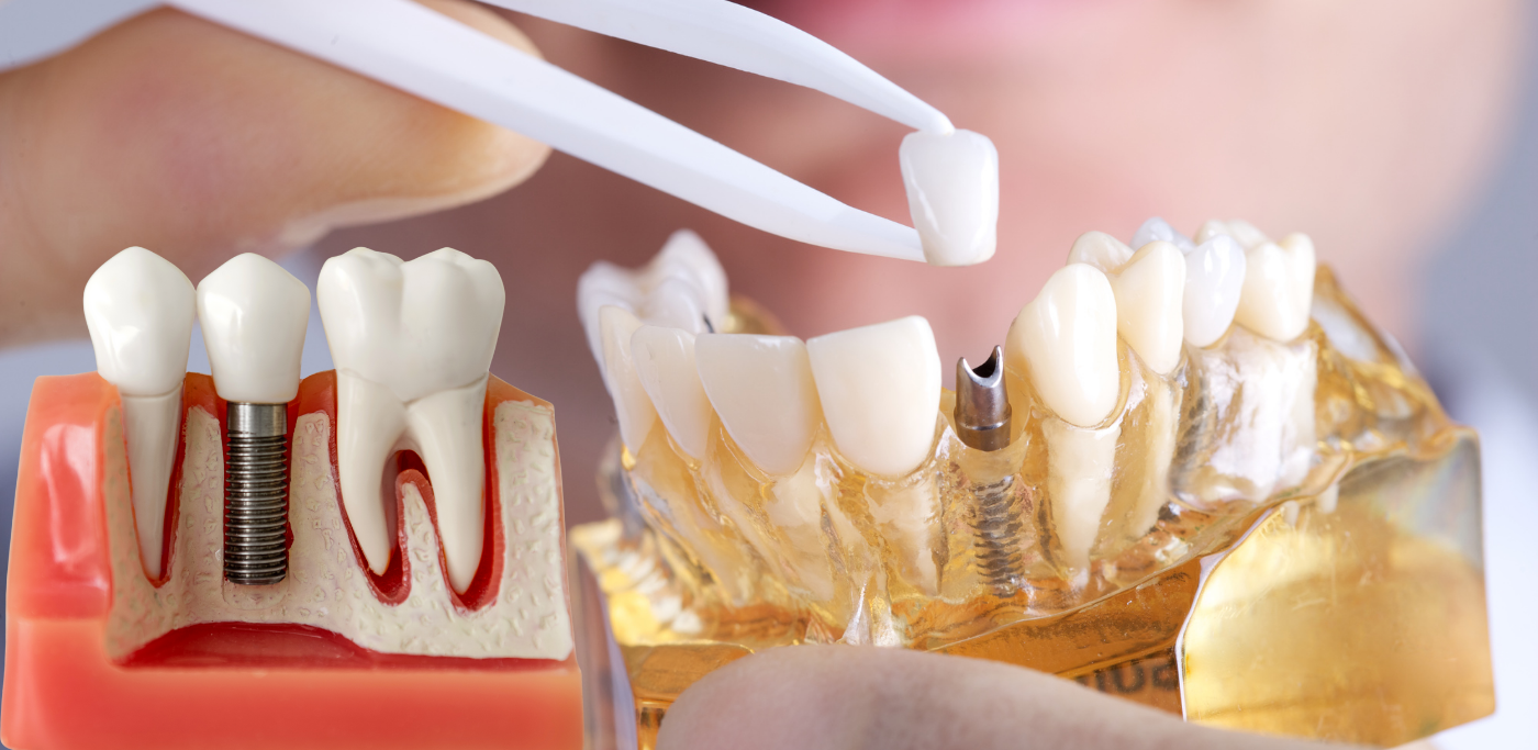 Dental Implants in Ghaziabad Just Got Smarter: Experience 3D-Guided Precision at Kutumb Dental
