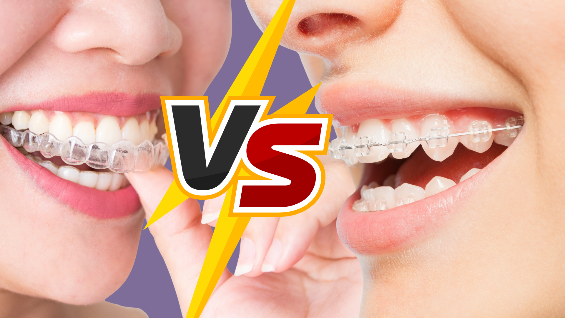Dental Aligners vs. Braces: Which is Best for Teens & Adults in 2025?