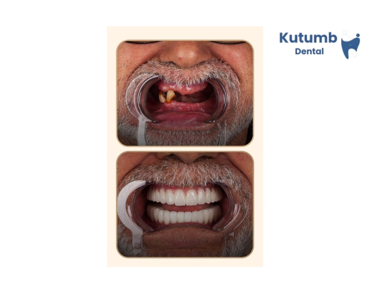 Top Dental Clinic in Ghaziabad – Kutumb Dental Care