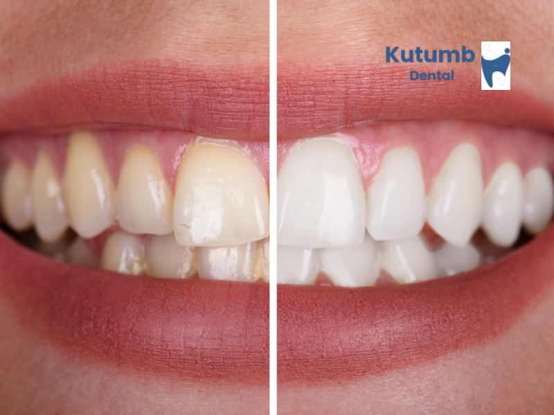 Best Teeth Cleaning Near Me Ghaziabad Best Teeth Cleaning Near Me Ghaziabad