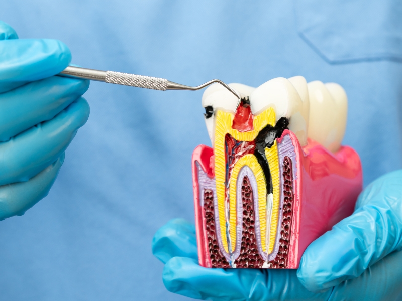 Best Endodontist Near Me: RCT Experts Ghaziabad Root Canal Treatment