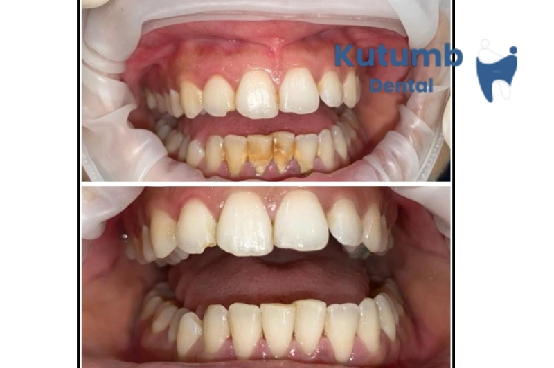 Best Dentist in Vasundhara Ghaziabad | Kutumb Dental