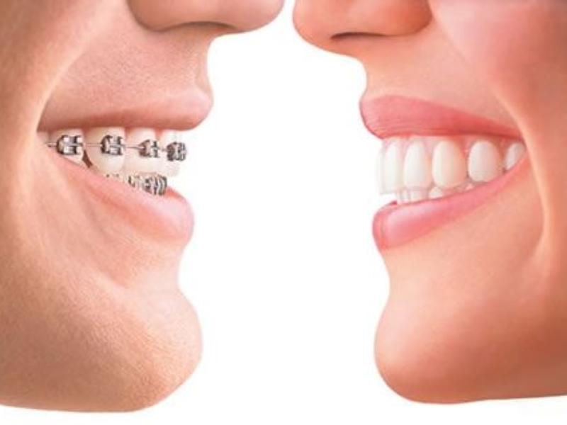 Dental Implants vs Braces: Smile Guide