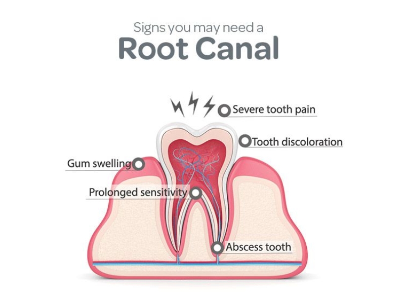 Do You Really Need a Root Canal? Signs You Should Not Ignore