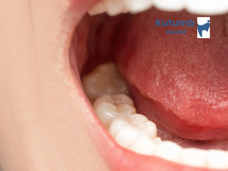Impacted Wisdom Teeth: Signs You May Need Tooth Removal