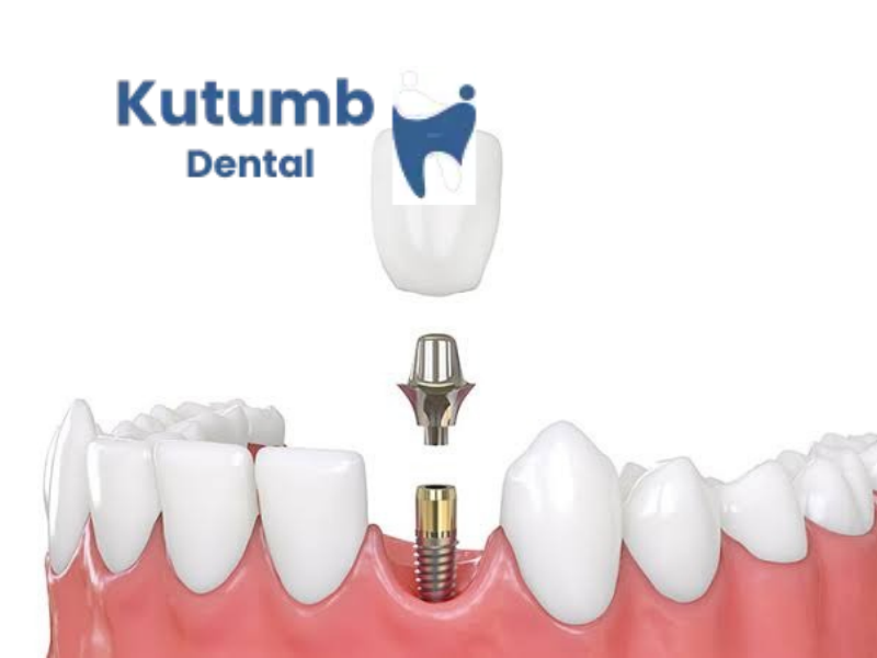 Dental implants in Ghaziabad at Kutumb Dental Clinic