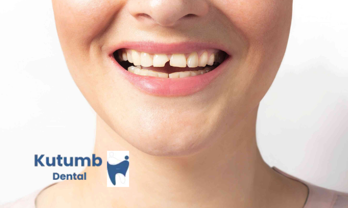 Cracked Tooth Treatment