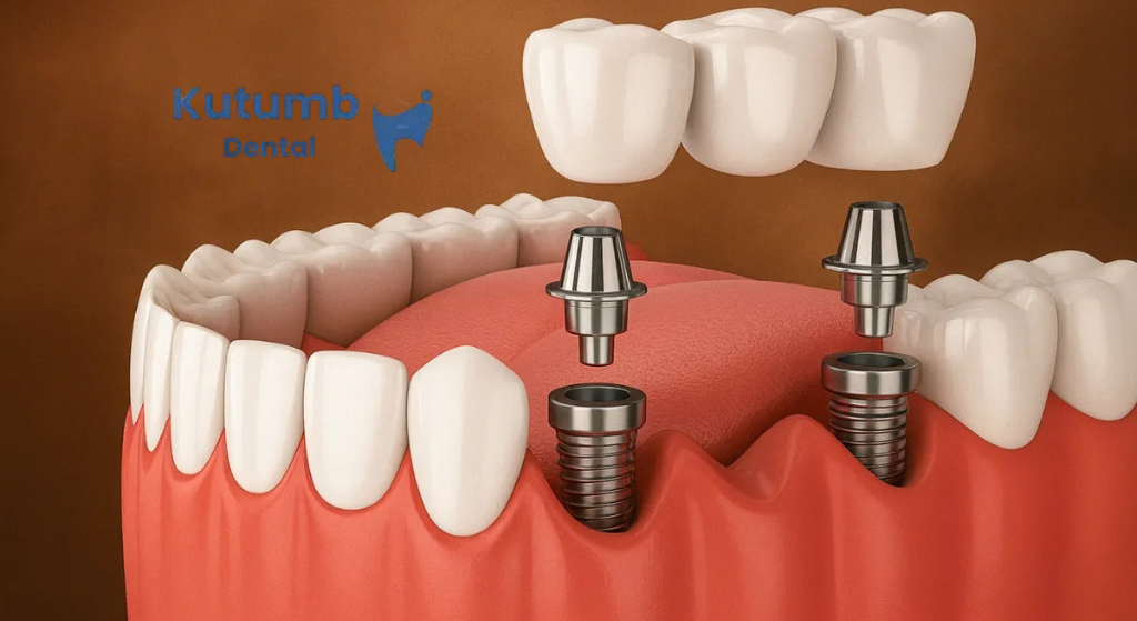 Dental Implants in Ghaziabad: Procedure, Benefits, Recovery & Aftercare