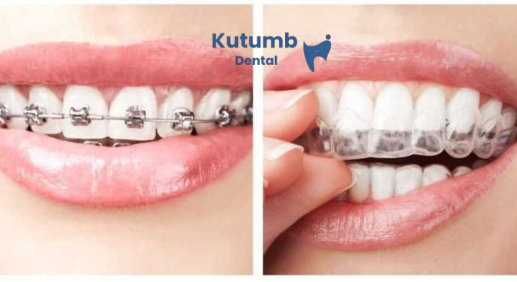 Braces vs Clear Aligners: Which Orthodontic Treatment Is Right for You?