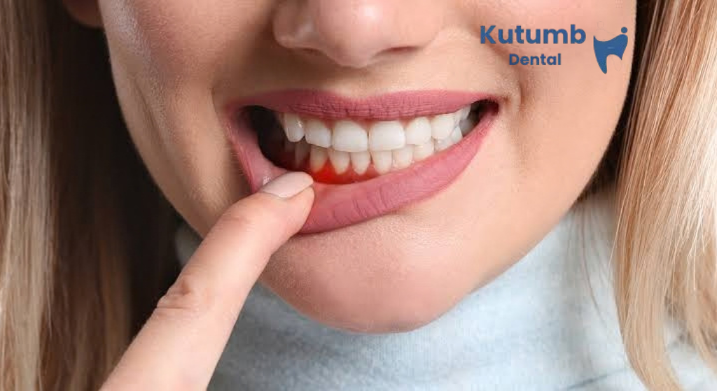 Swollen gums causes, symptoms and treatment in Ghaziabad