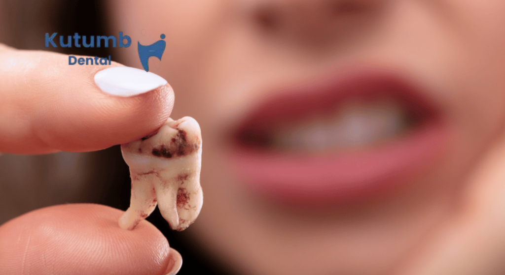 Tooth Decay: Stages, Warning Signs & Treatment Options